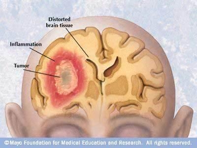 imagini tumori cerebrale